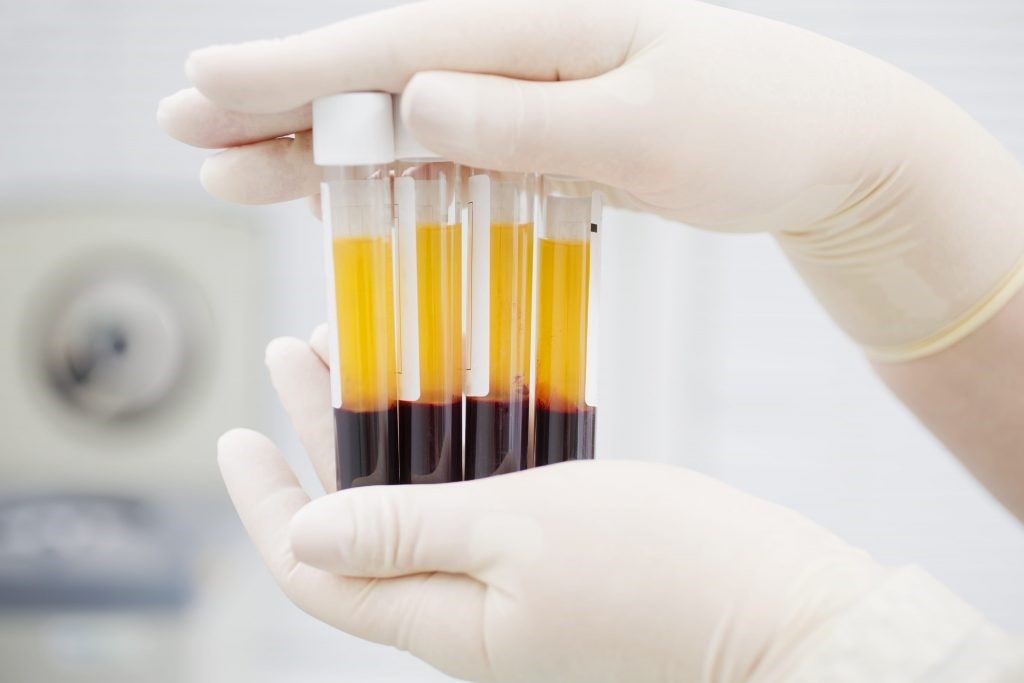 Lee más sobre el artículo Tratamiento con Plasma Rico en Plaquetas (PRP)